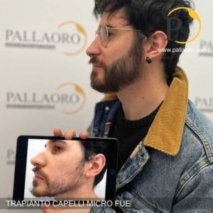 trapianto barba incompleta