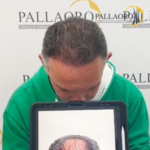 trapianto-capelli-34