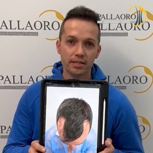 trapianto-capelli-36