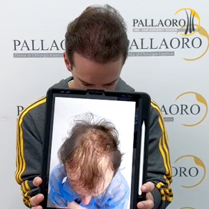 trapianto-capelli-37