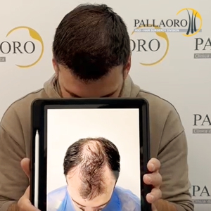 trapianto-capelli-38