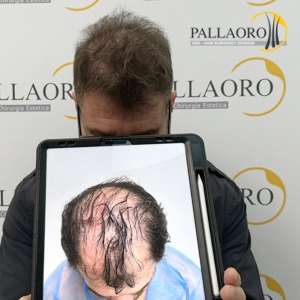 trapianto-capelli-39