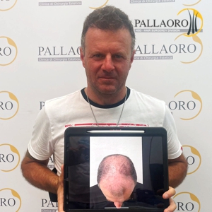 trapianto-capelli-40