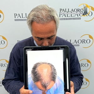 trapianto-capelli-42