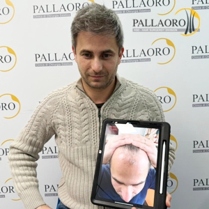 trapianto-capelli-43