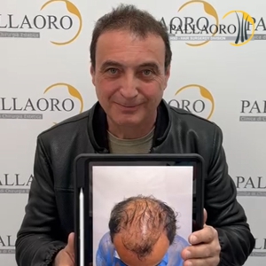 trapianto-capelli-45