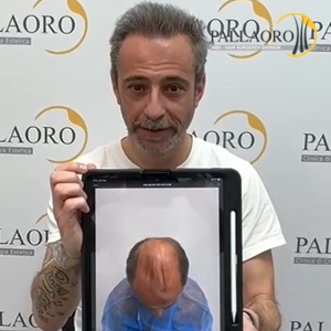 trapianto-capelli-46