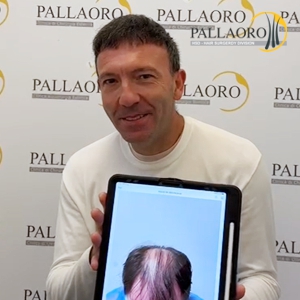 trapianto-capelli-47