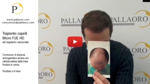 trapianto capelli alopecia androgenetica severa video 05