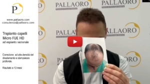 trapianto capelli alta densita diradamento capelli e stempiature video 03