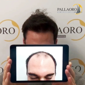 trapianto capelli calvizie estesa