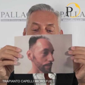 trapianto capelli christian