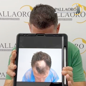 trapianto-capelli-cicatrice-ustione
