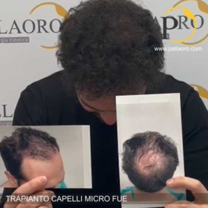 trapianto capelli diradamento severo e calvizie al vertex