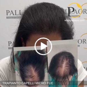 trapianto capelli donna giovane diradata