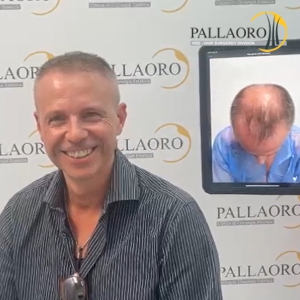 trapianto-capelli-dopo-6 mesi-2