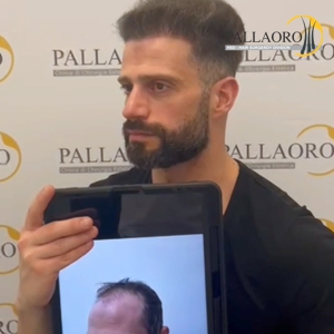 trapianto capelli dopo 8 mesi
