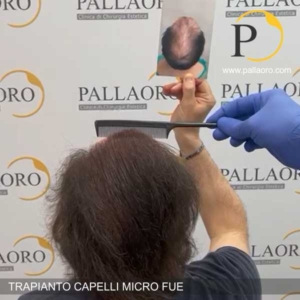trapianto capelli uomo calvizie estesa