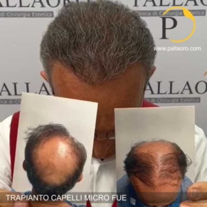 trapianto capelli uomo calvizie estrema dopo 1 anno