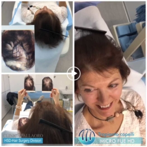 trapianto-capelli-video-01