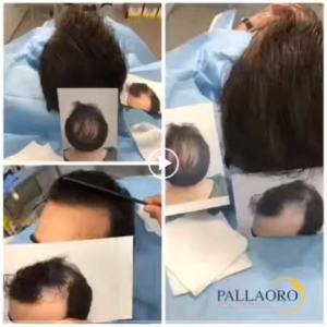 trapianto-capelli-video-02