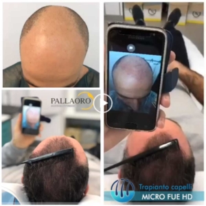 trapianto-capelli-video-03