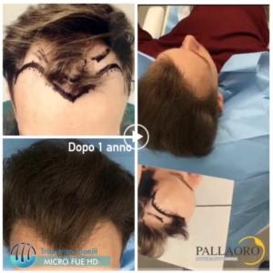 trapianto-capelli-video-04