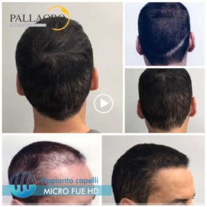 trapianto-capelli-video-05
