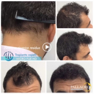 trapianto-capelli-video-06
