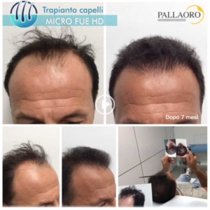 trapianto-capelli-video-07