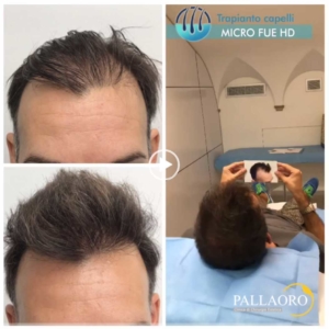 trapianto-capelli-video-08