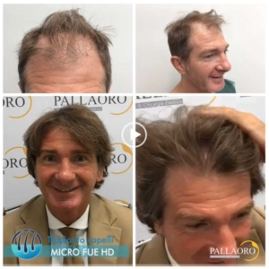 trapianto-capelli-video-09