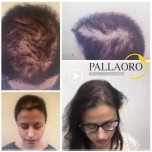 trapianto-capelli-video-10