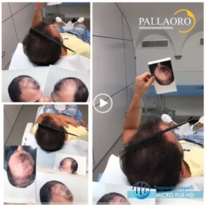 trapianto-capelli-video-11