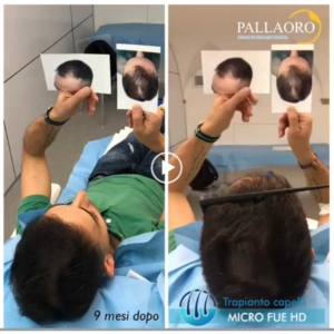 trapianto-capelli-video-12