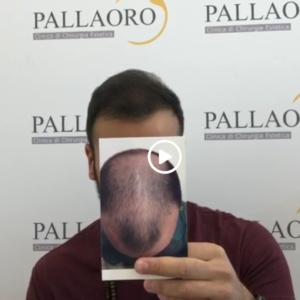 video trapianto capelli 13c